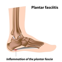 Common Risk Factors and Symptoms of Plantar Fasciitis