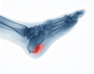 When Surgery Is Needed for Heel Spurs