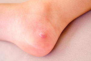 Facts About Foot Blisters