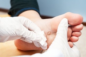 How to Spot a Plantar Wart on Your Child’s Feet