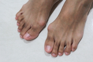 Bunion Deformities