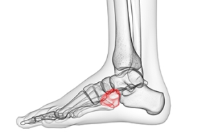 Running and the Cuboid Bone
