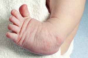Managing Clubfoot