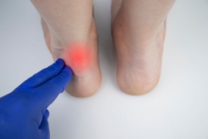 Achilles Tendon Injuries in Athletes