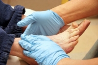 Diabetes and Severe Foot Problems